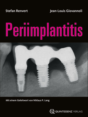 Periimplantitis Periimplantitis